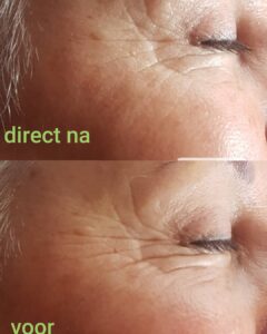 Resultaat microneedling voor en direct na